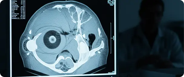 Eye Injury Lawyer in L.A