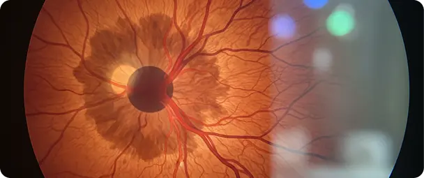 Eye Injury Lawyer in L.A